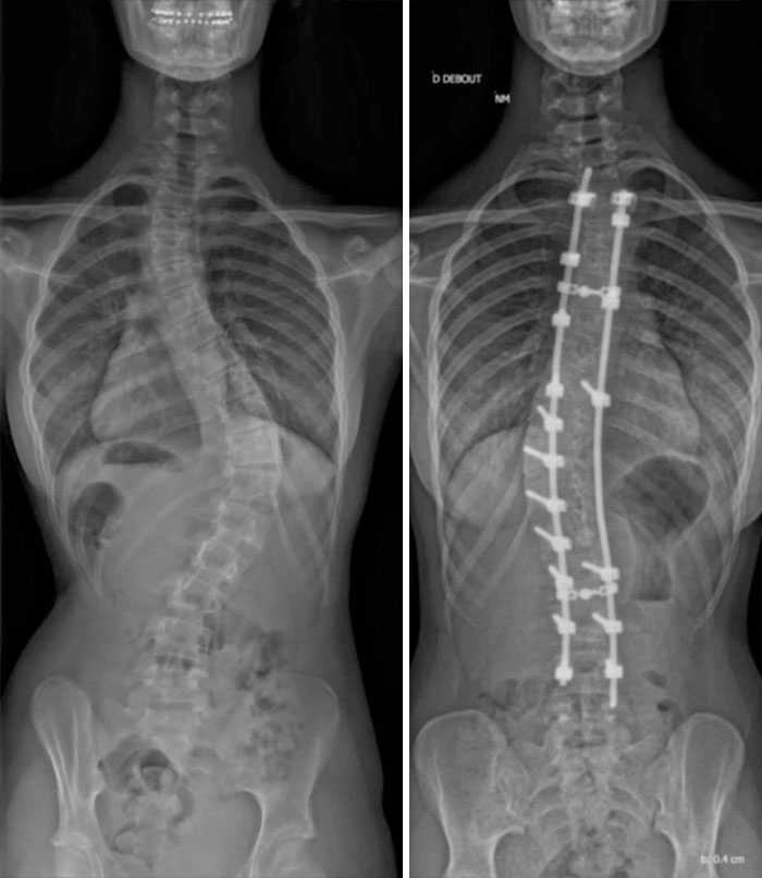 6 Years Ago Today I Had A Surgery To Straighten Up My Spine, This Is The Before And After Result. I Gained 5 Cm With The Process