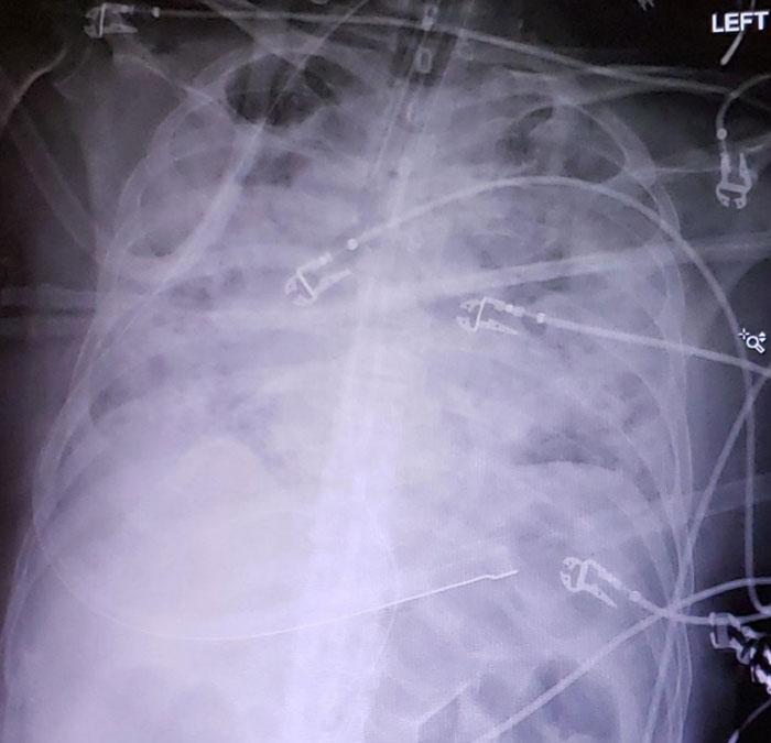 I Took This X-Ray On A Covid+ Patient Hours After My Friend Tried To Tell Me Covid Isn't That Bad