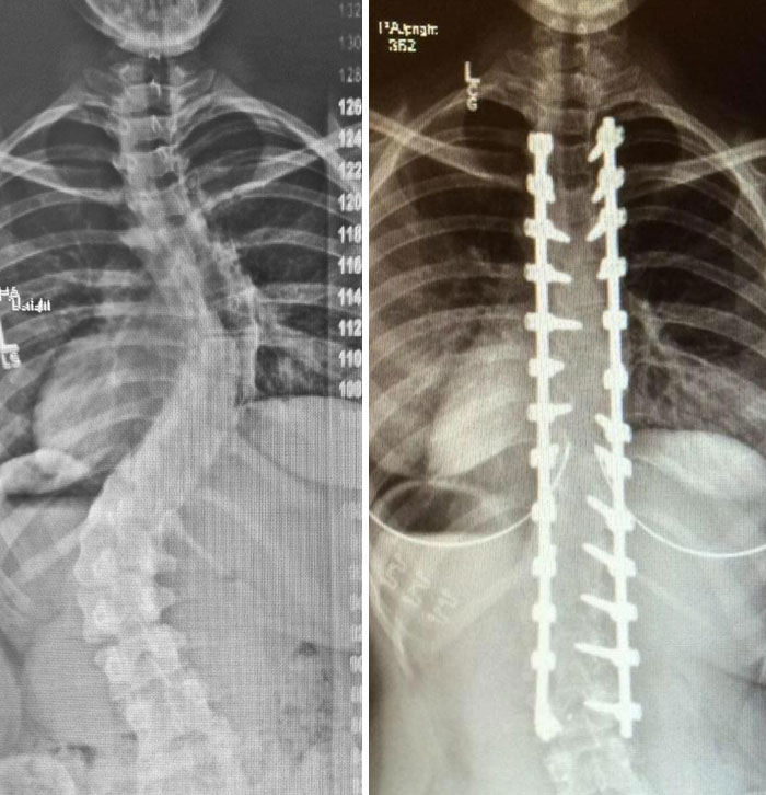 X-Rays Of My Spinal Fusion Surgery Before And After