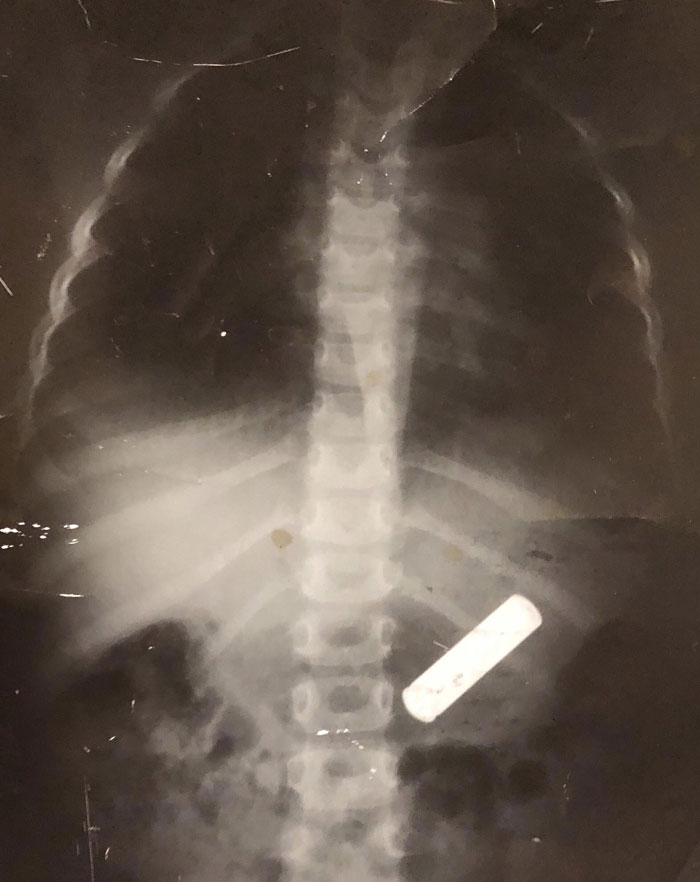Swamy X-Ray From When I Was 3 And Swallowed An AA Battery