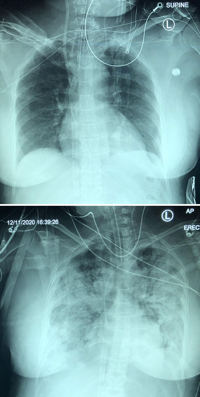5-Day Progression Of Covid Pneumonia