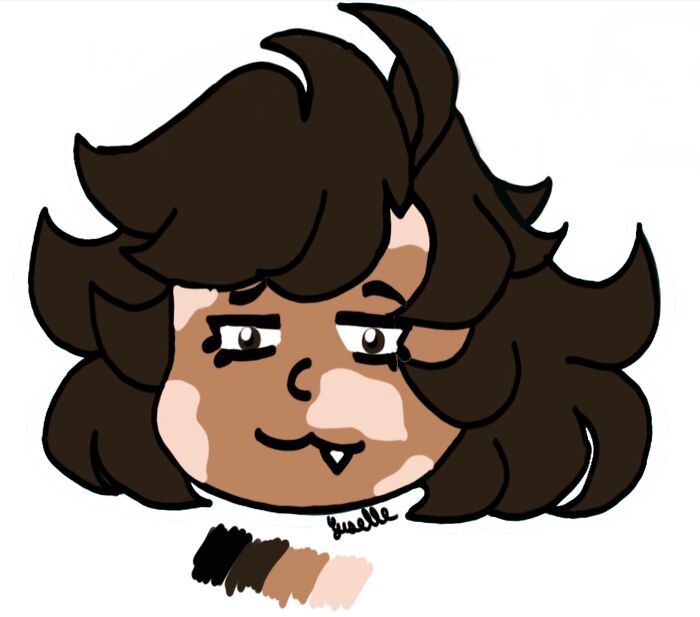 My Sona Yes I Have Vitiligo Yes I’ve Been Keeping It A Secret And Yes I Think It’s About Time I Stop Being Insecure About It