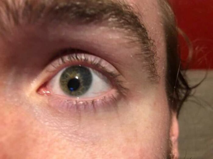 Off-Center Pupil I've Had Since Birth