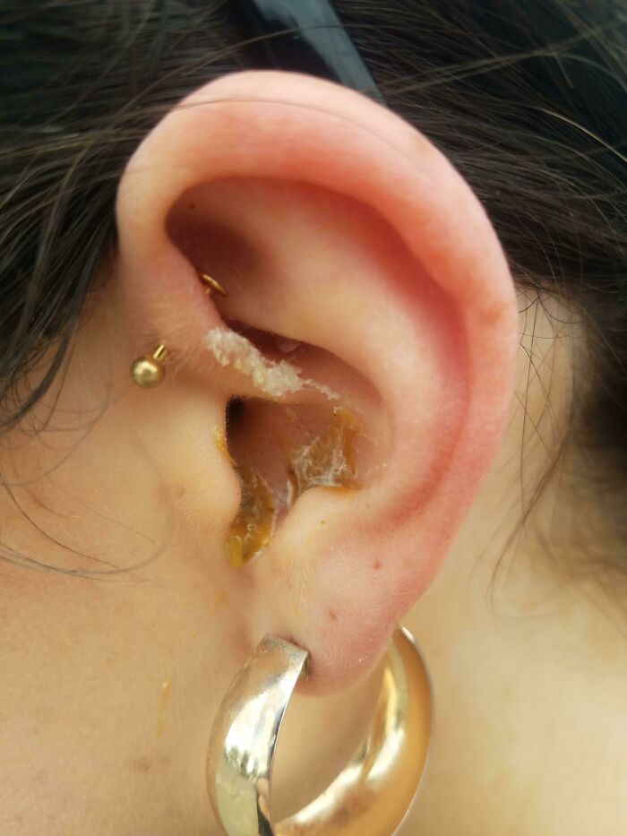 A Seagull Somehow Managed To Poop Directly Into My GF's Ear While She Was Walking