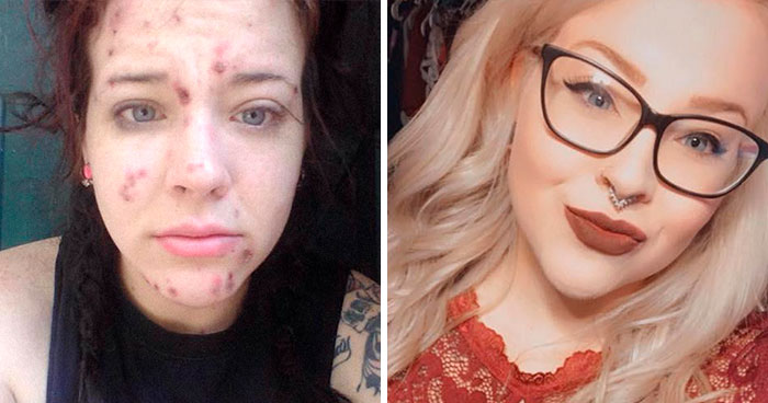 ‘The Addict’s Diary’ Showcases Before & After Transformations Of People Who Quit Drugs (30 Stories)