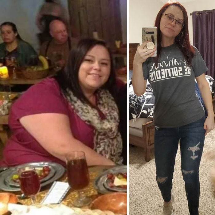 320>144 = 176 Lbs, 4,5 Years On WW. Finally Had Skin Removal Surgery Done. Breast Lift And Extended Tummy Tuck