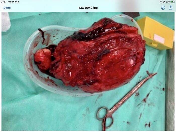 I Asked The Surgeon To Take A Phone Of My Fibroid For Me!
