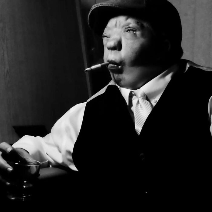 I Was Doing A Noir Challenge... And For Those Who Are Curious It Is Called Goldenhar Syndrome.