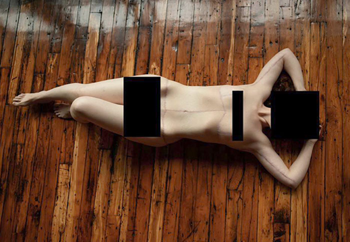 I Lost 170 Lbs, Then Had 9lbs Of Excess Skin Removed. My Scars Make Me Look Like An IRL Sally From The Nightmare Before Christmas