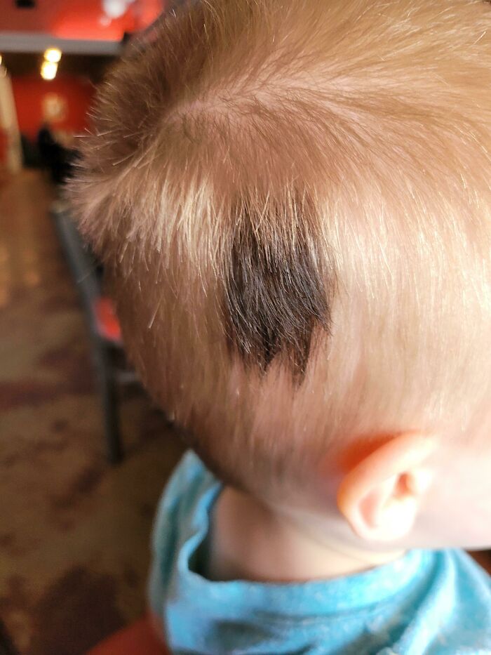 My Son Was Born With A Black Spot Of Hair In His Blonde Hair. It Grows In Black, And There Is No Birth Mark Or Discoloration Under It