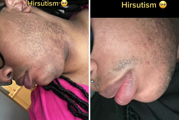 A TikToker Shares Her Experience With Hirsutism In Hopes Of Raising Awareness And Educating People On The Condition A TikToker Shares Her Experience With Hirsutism In Hopes Of Raising Awareness And Educating People On The Condition