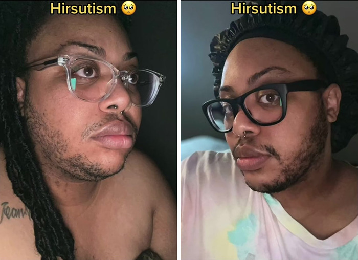 A TikToker Shares Her Experience With Hirsutism In Hopes Of Raising Awareness And Educating People On The Condition A TikToker Shares Her Experience With Hirsutism In Hopes Of Raising Awareness And Educating People On The Condition