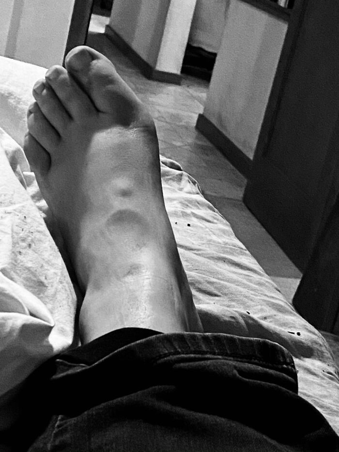 Just My Foot Cosplaying Death Star (Ehlers Danlos)