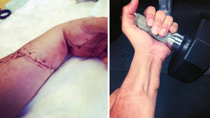 Never Thought I’d Be Able To Use My Hand Again. Shout Out To The Surgeon And Therapist