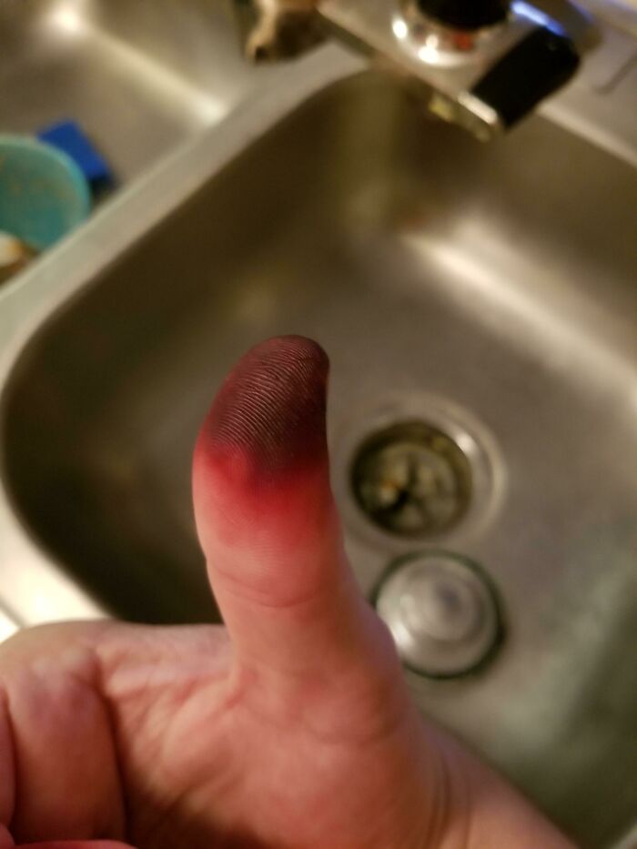 Helped Dye My Fiancé's Hair Last Night. Didn't Notice That The Gloves Had A Small Hole Until I Took Them Off