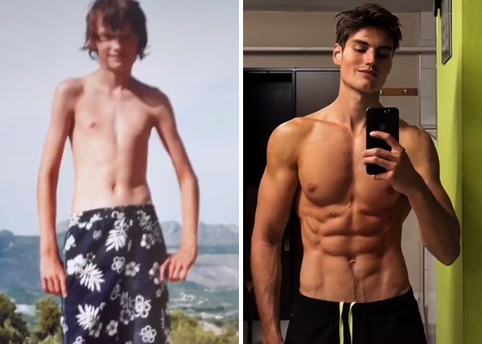 89 People Who Were Hit Hard By Puberty Share Their Before & After Pics.