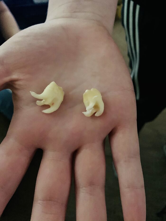 Two Of My Wisdom Teeth. They Were Completely Sideways