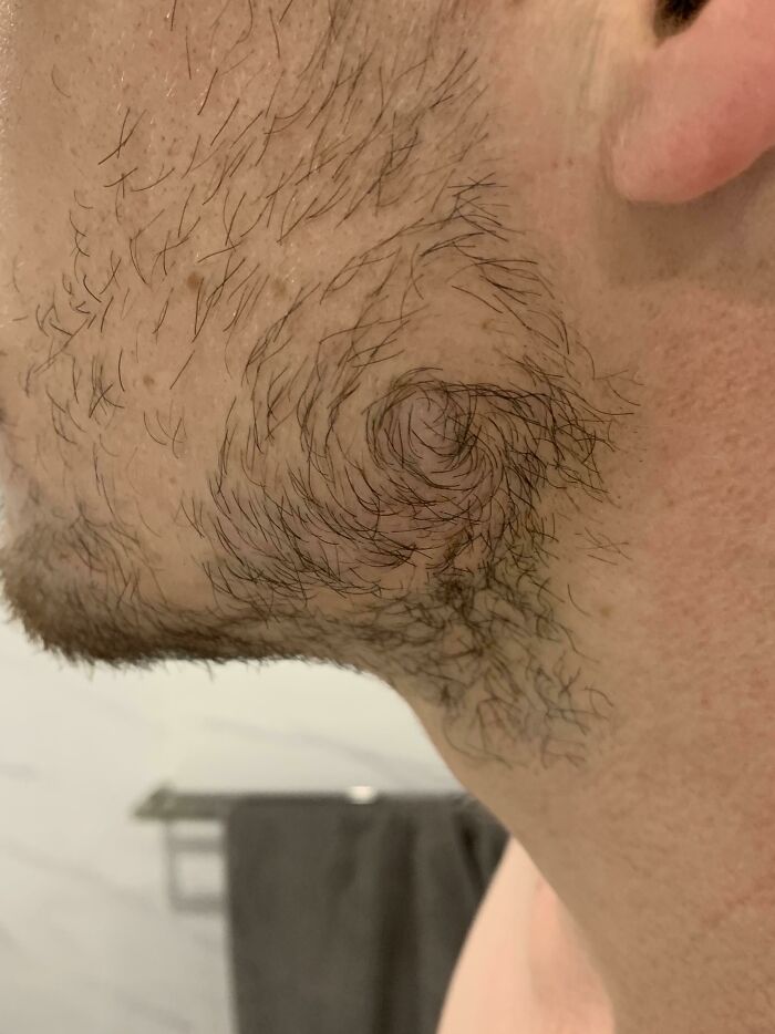 One Side Of My Facial Hair Turns Into A Swirl Near My Cheekbone