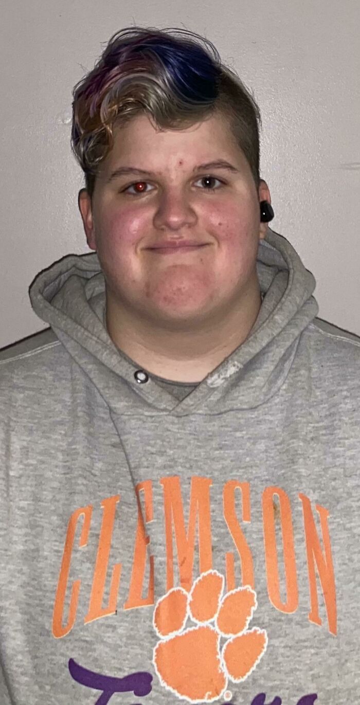 I’m Partially Blind In My Left Eye. It Doesn’t Show Any “Red Eye” In Photos