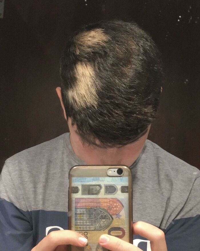 My Natural Hair Is Brown With Blonde Patches