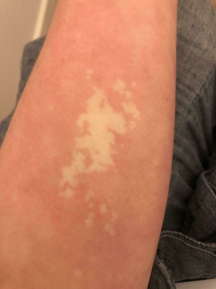 I Got Stung By A Jellyfish 20 Years Ago That’s Effected The Cells In My Skin Meaning It Can’t Change Colour Due To Temperature