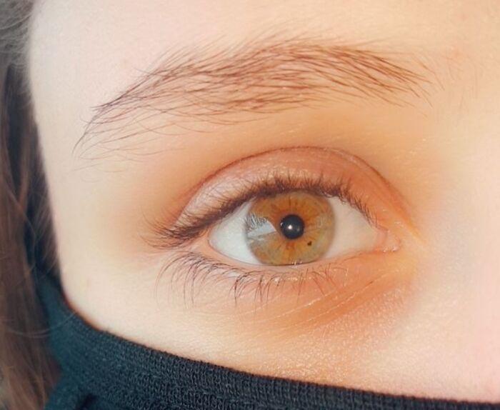 I Have A Heart Shaped Birthmark In My Eye