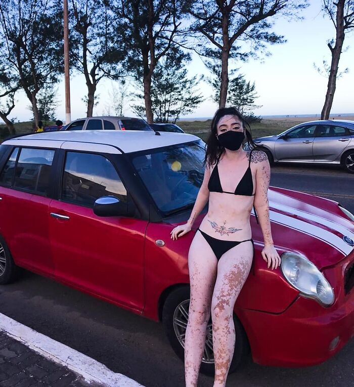 Woman With Vitiligo Overcomes Her Self-Confidence Issues After A Photoshoot With Famous Makeup Artist