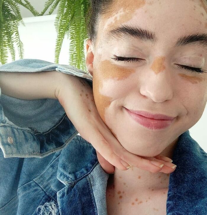 Woman With Vitiligo Overcomes Her Self-Confidence Issues After A Photoshoot With Famous Makeup Artist