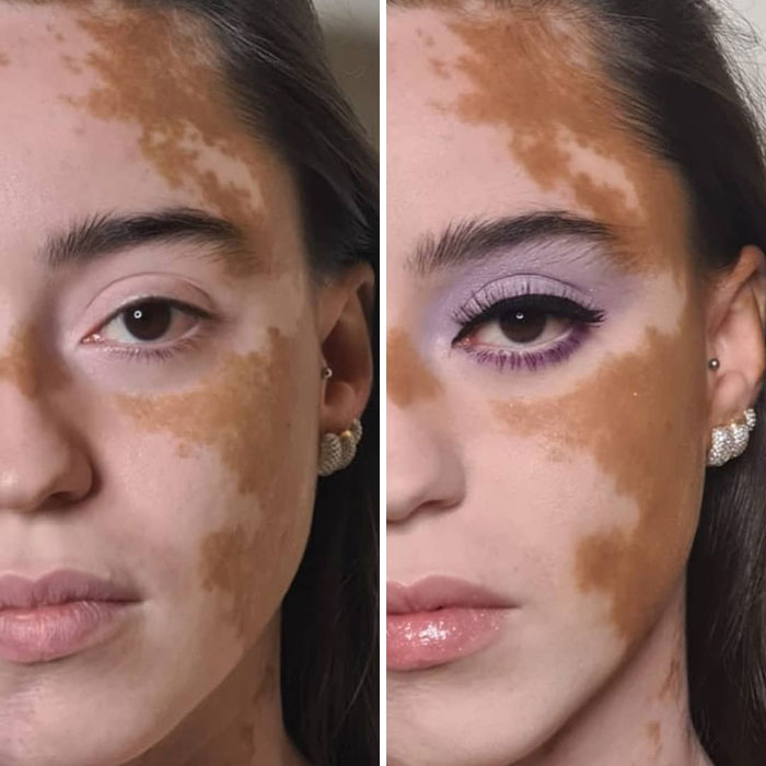 Woman With Vitiligo Overcomes Her Self-Confidence Issues After A Photoshoot With Famous Makeup Artist