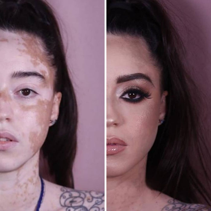 Woman With Vitiligo Overcomes Her Self-Confidence Issues After A Photoshoot With Famous Makeup Artist