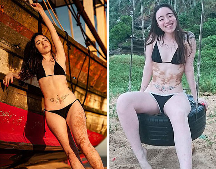 Woman With Vitiligo Overcomes Her Self-Confidence Issues After A Photoshoot With Famous Makeup Artist