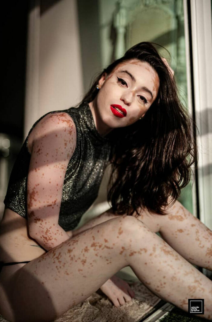 Woman With Vitiligo Overcomes Her Self-Confidence Issues After A Photoshoot With Famous Makeup Artist