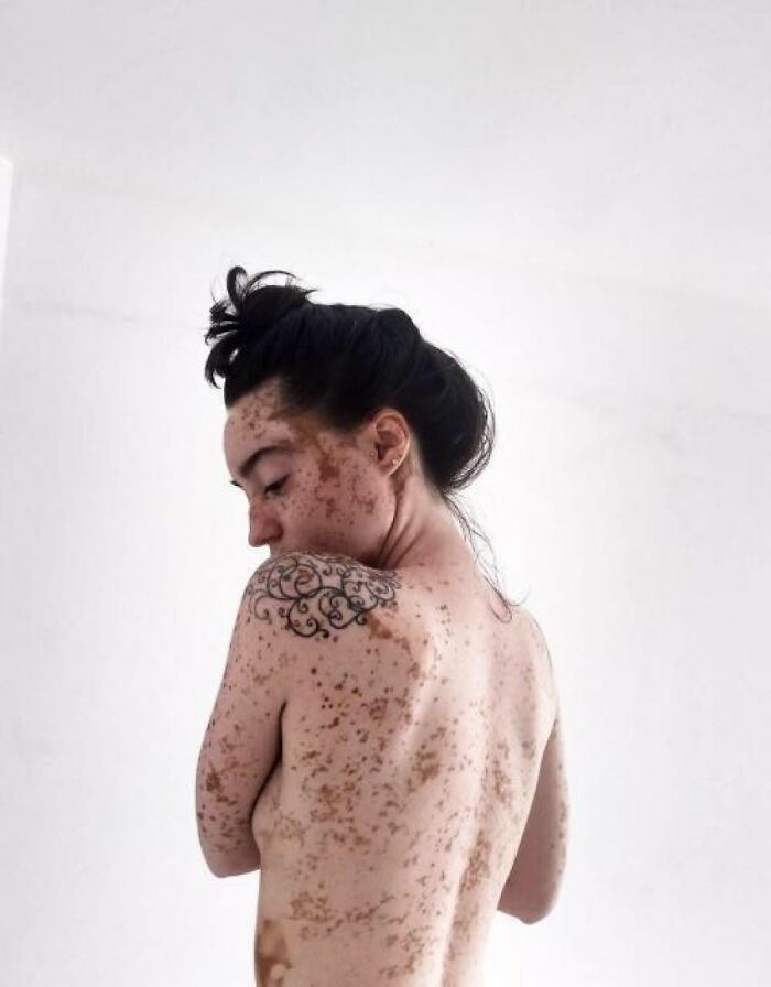 Woman With Vitiligo Overcomes Her Self-Confidence Issues After A Photoshoot With Famous Makeup Artist
