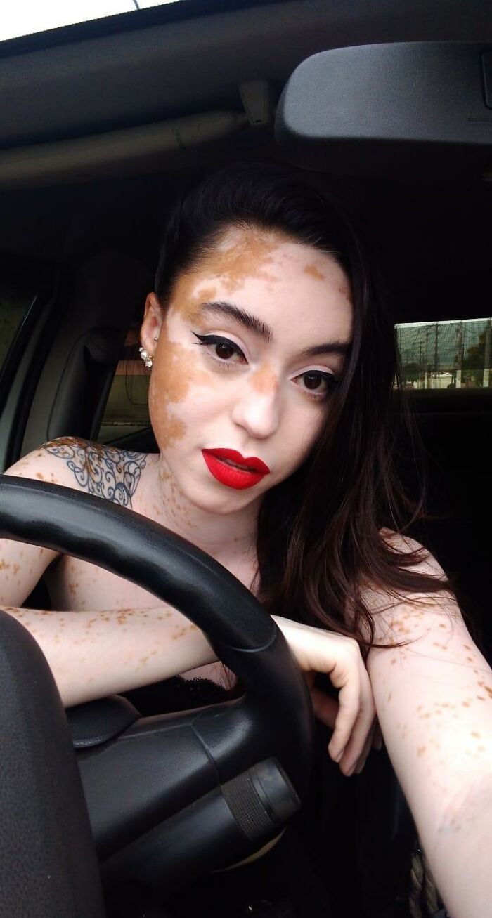 Woman With Vitiligo Overcomes Her Self-Confidence Issues After A Photoshoot With Famous Makeup Artist