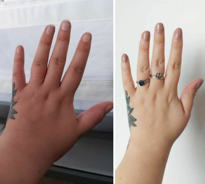 35 Weeks Pregnant Today, And I've Had To Give Up And Take My Wedding Ring Off Because Of Swelling And It Hurts To Move My Fingers. Joys Of A Summer Baby