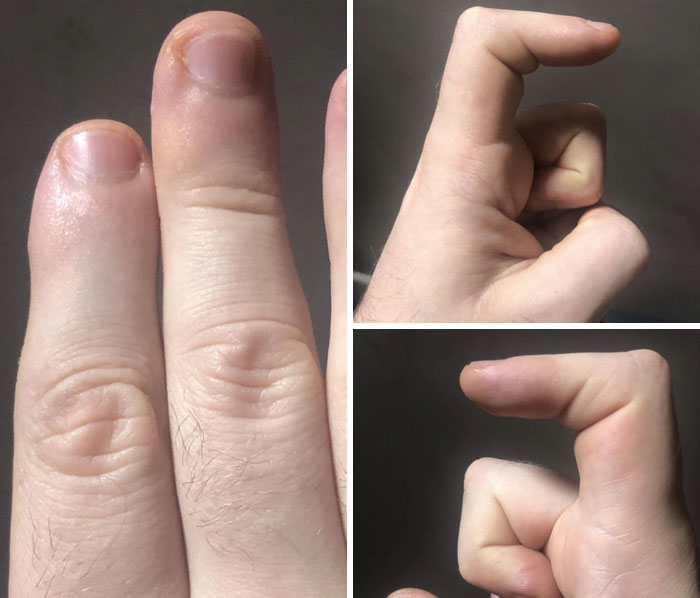 My Pointer Fingers Are Missing Their Topmost Joints. I Can Only Bend Them At A Right Angle