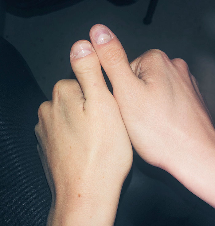 I Have Fraternal Thumbs, 1 From Each Parent Due To A Genetic Mutation On My Dad's Side (Unilateral Brachydactyly Type D)