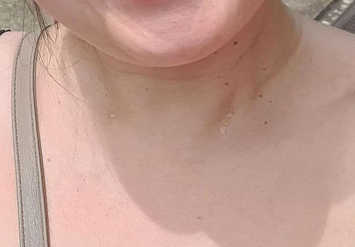 I Have Pin-Sized Holes Either Side Of My Neck That Leak Sinus Fluid. I Believe They Are A Congenital Birth Defect Called Branchial Cleft Fistulae