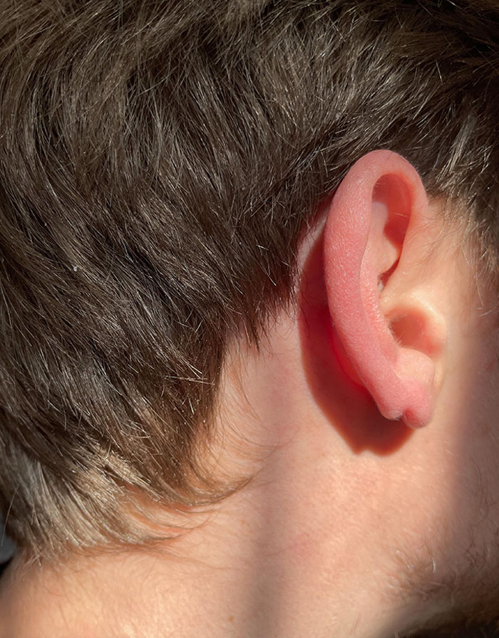 I Have A Double Earlobe