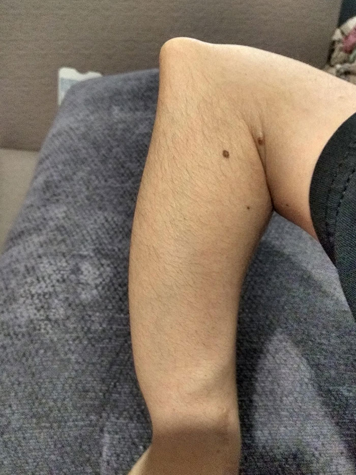 I Have Rare A Hereditary Disorder Called Multiple Hereditary Exostosis Which Causes Bone Growths On Various Body Parts