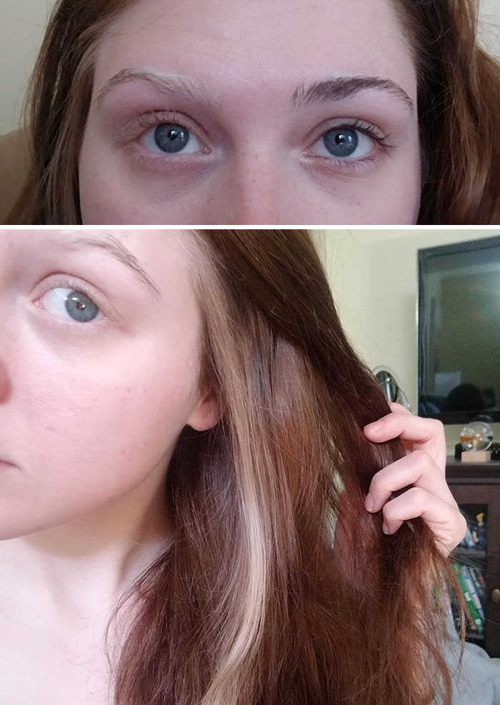 Poliosis Is The Localized Depigmentation Of Hair Follicles Resulting In A White Streak