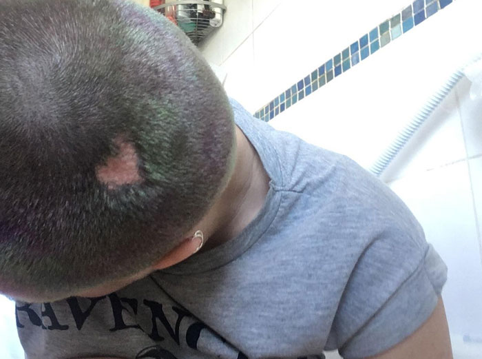 I Was Born With A Heart On My Head (Birthmark)