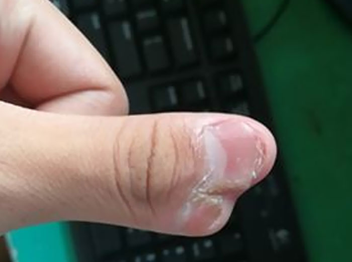 My Thumb Has Another Thumb Sprouting Out Of It