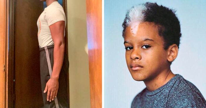 50 Photos Of Unique People’s Features Because Of Their Rare Genetics (New Pics)