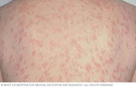 pityriasis-rosea-612e365c1949a.jpg