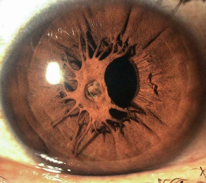 An Iris Growing Over A Pupil