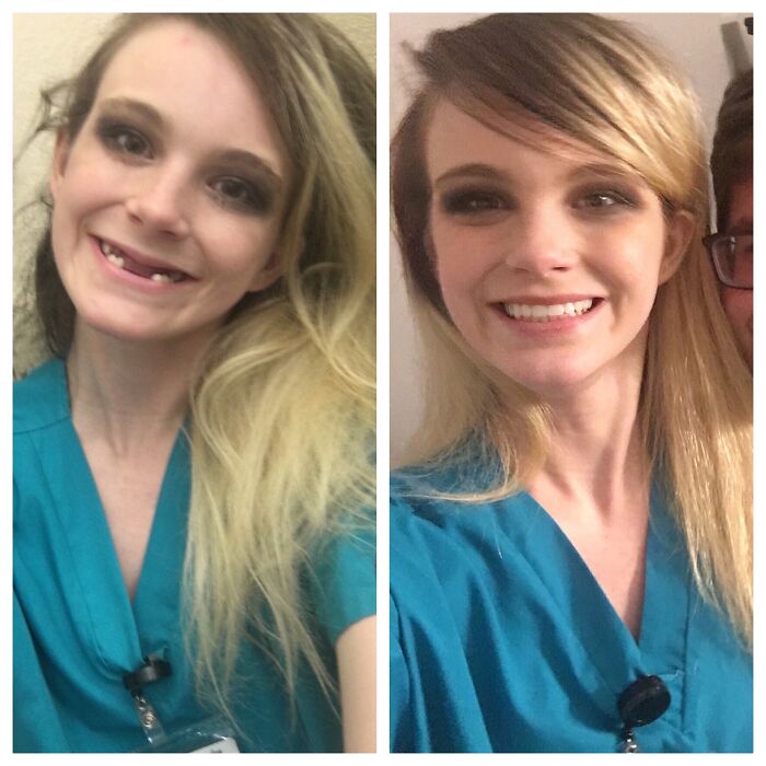 Bulimia Recovery - Before/After Teeth Restoration