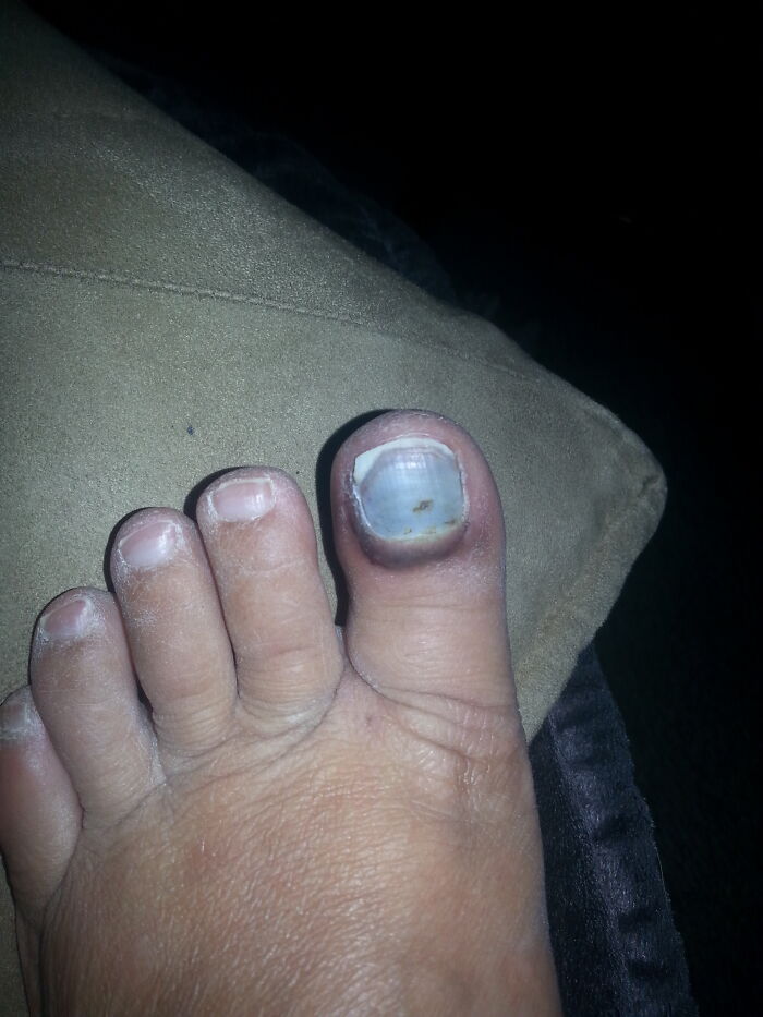 Dropped A Baking Sheet Edge First On My Toe, Turned This Pastel Blue Before Finally Turning Black And Falling Off....