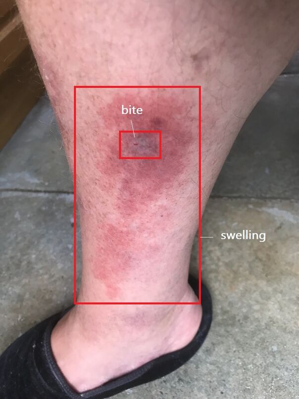 False-Widow-Bite-July-2021-61556511df607.jpg