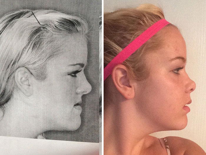 The Before And After Of My Jaw Surgery